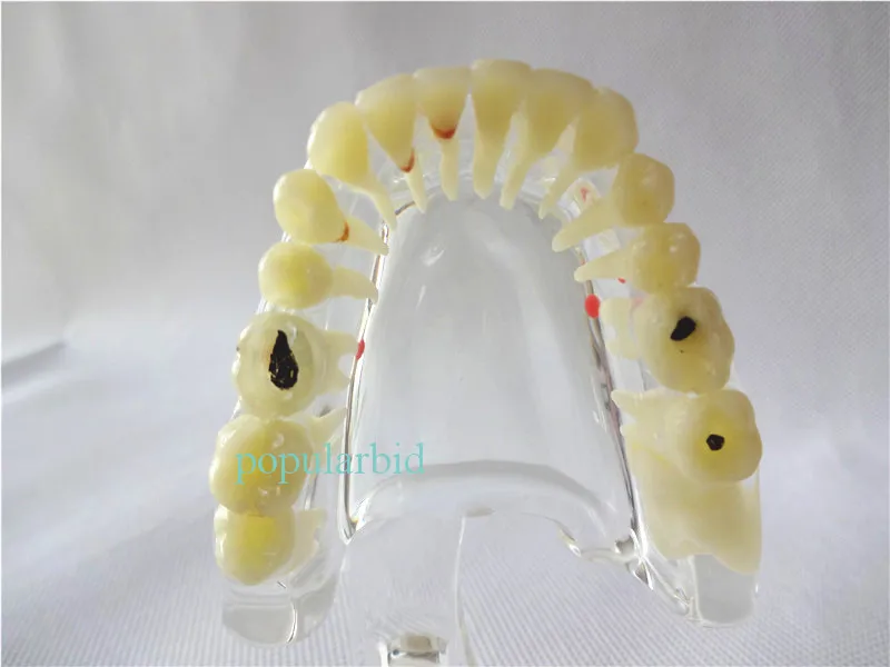Зубные имплантаты болезни зуб патологических экструзии отсутствующих зубов Модель 4001