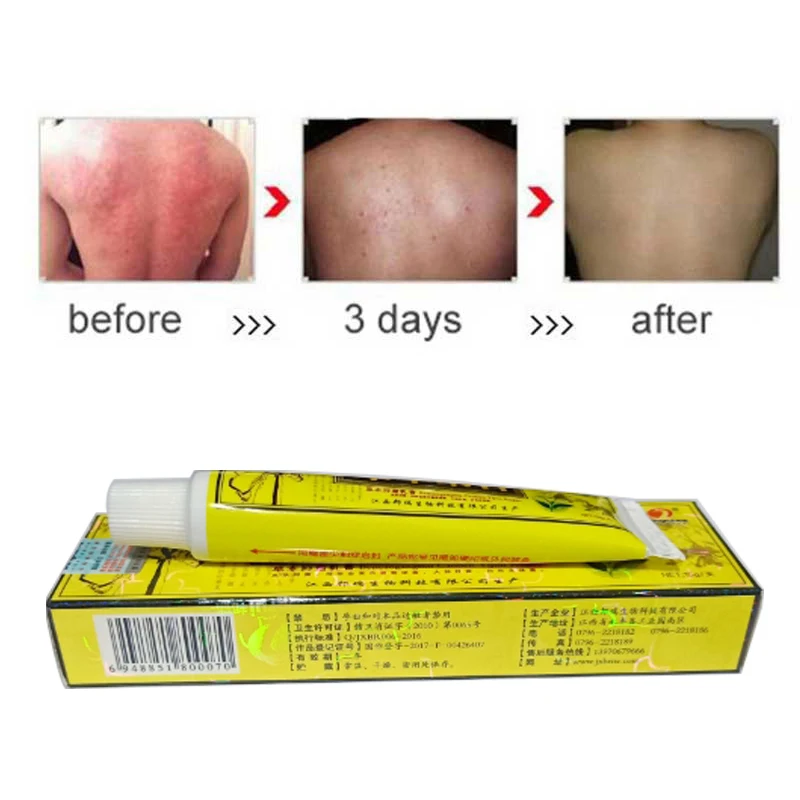 

Body Psoriasis Cream Perfect For Dermatitis and Eczema Pruritus Psoriasis Ointment Herbal Creams