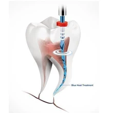 6 фото стоматологические ресипрок синие файлы Гуттаперчевые наконечники endodontic niti файлы использовать для очистки корневого канала стоматология