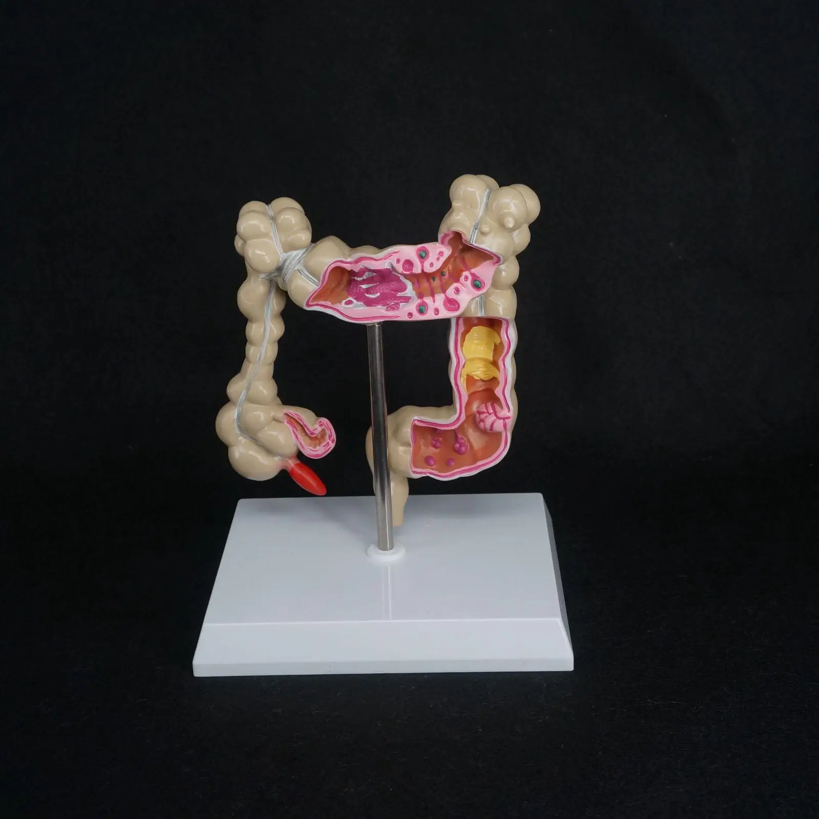 Патологические болезни толстой кишки человека модель орган, анатомия обучающие материалы