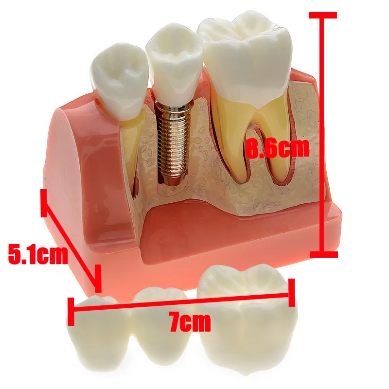 4 раза зубной имплантат, зубы, модель с реставрационным мостом, коронка для медицинских исследований, Обучающие инструменты для стоматолога