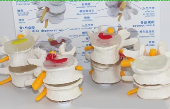 

4 pcs Lumbar spine pathology model lumbar vertebra model spine vertebral disc herniation