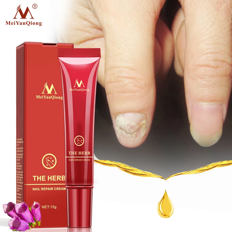 Meiyanqiong Nail Care Nail Repair Cream Anti Fungal 100% Nail Chinese Herbal Toe Nail Fungus Treatment High Quality Brand