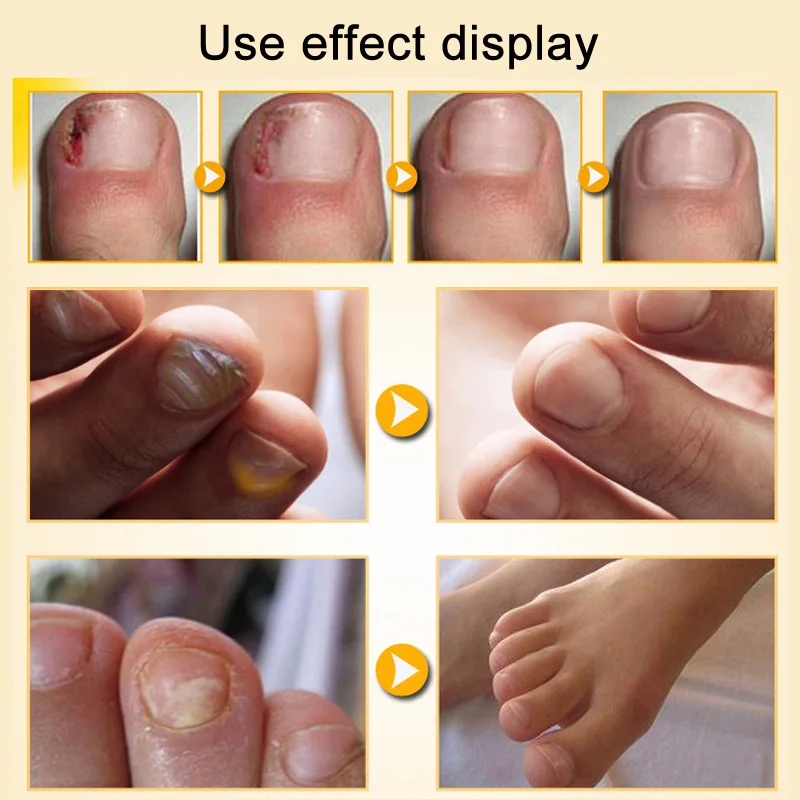 30ml Effective Nail Fungal Treatment Liquid for Toenail Fingernail Anti Fungus Infection Nail Care Herb Essence Fluid 30ml Effective Nail Fungal Treatment Liquid for Toenail Fingernail Anti Fungus Infection Nail Care Herb Essence Fluid