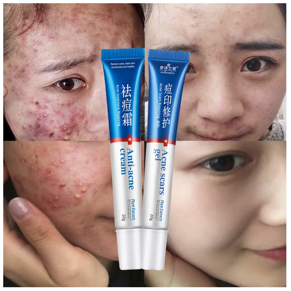 ISILANDON Face Care Clear Vanishing Acne Treatment Cream+Acne Scars