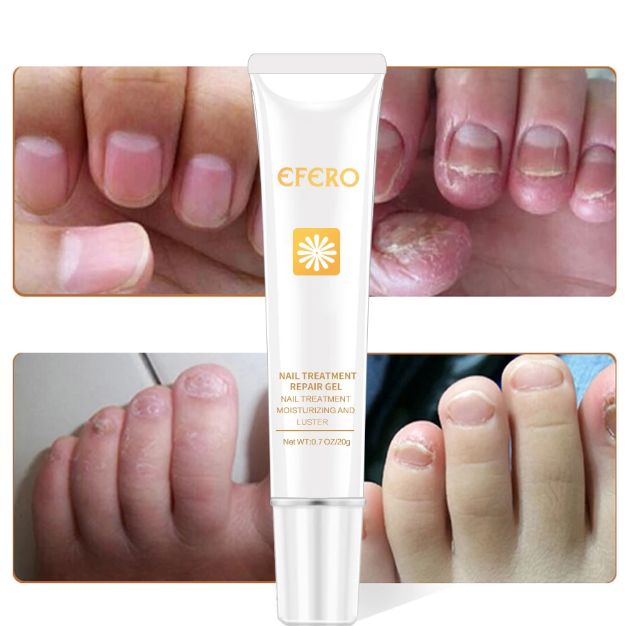 EFERO Nail Repair Essence Serum Fungal Nail Treatment Remove