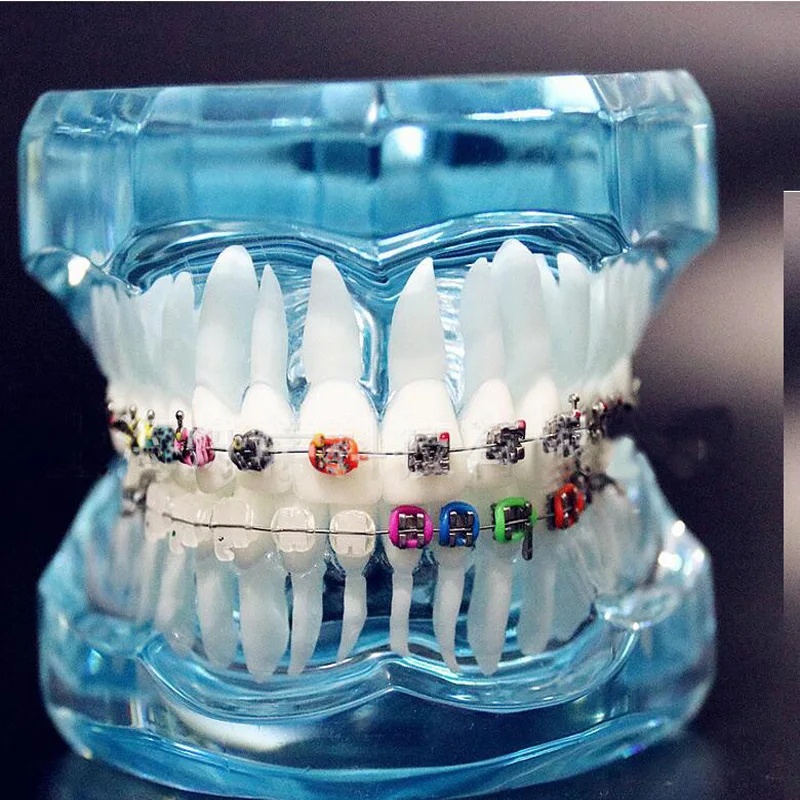 

Transparent Dental Orthodontic Mallocclusion Model with Brackets Archwire buccal tube Tooth Extraction for Patient Communication