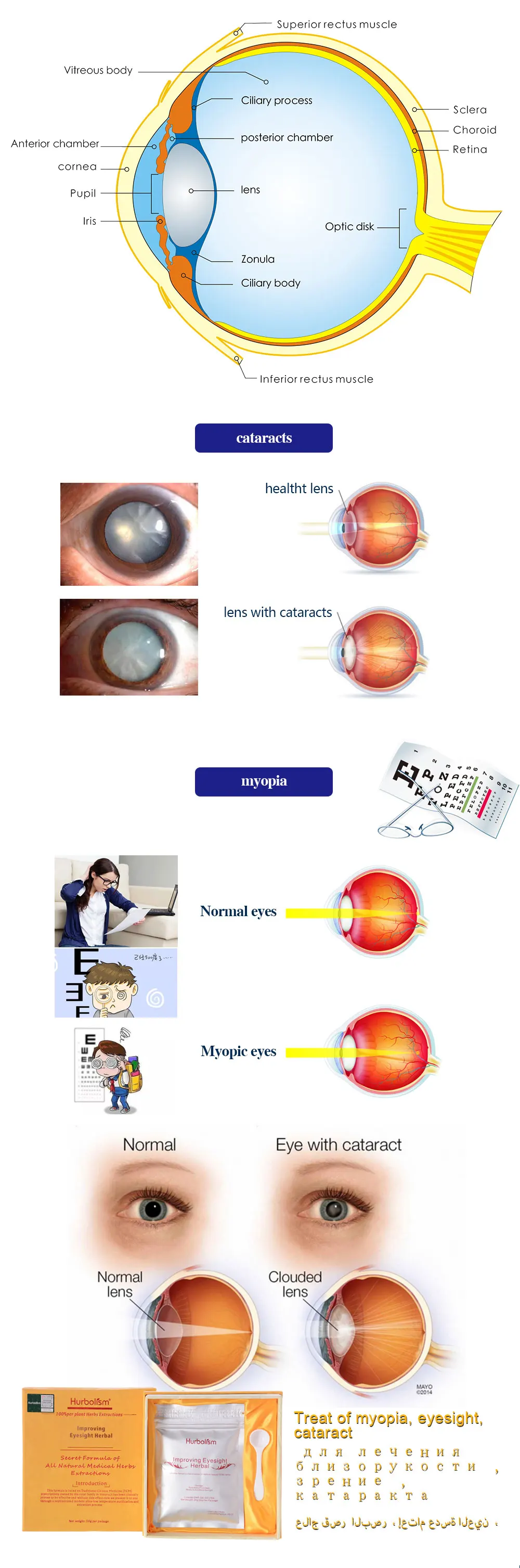 Hurbolism новое обновление улучшая зрение травяная формула лечения близорукости, предотвратить короткий прицел и катаракта защитить функции печенья