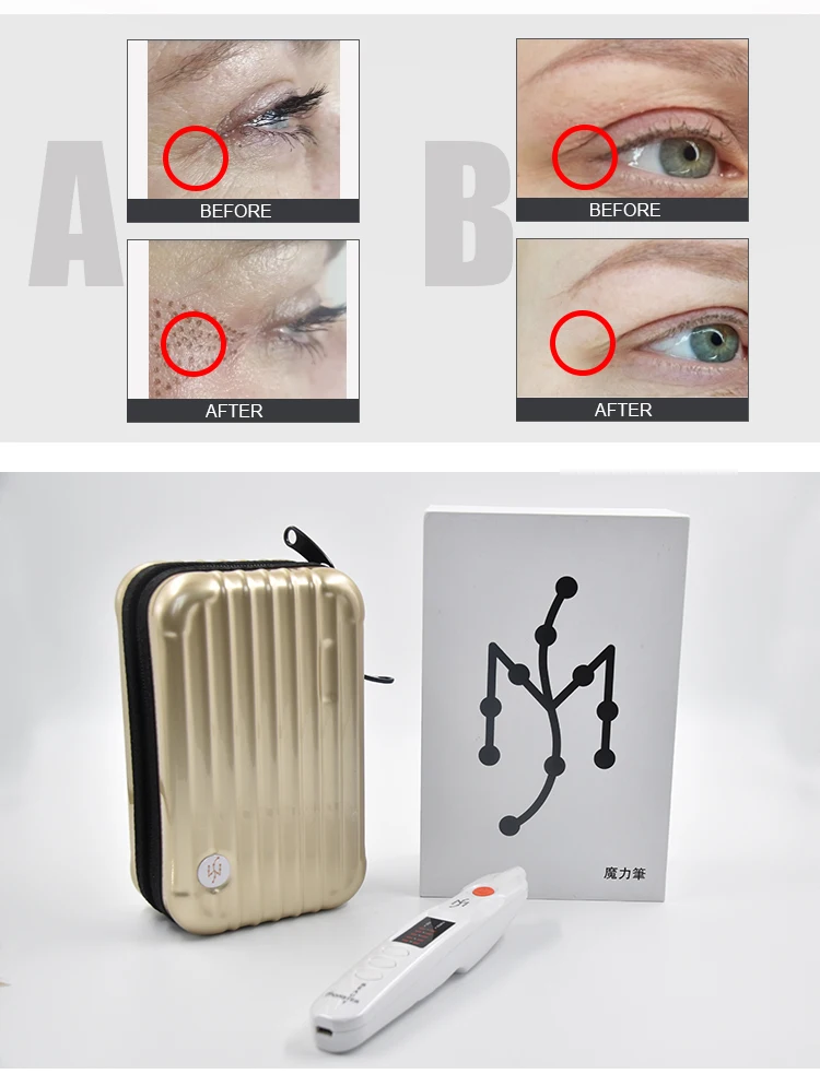 Plasma skin lifting light machine lift pen