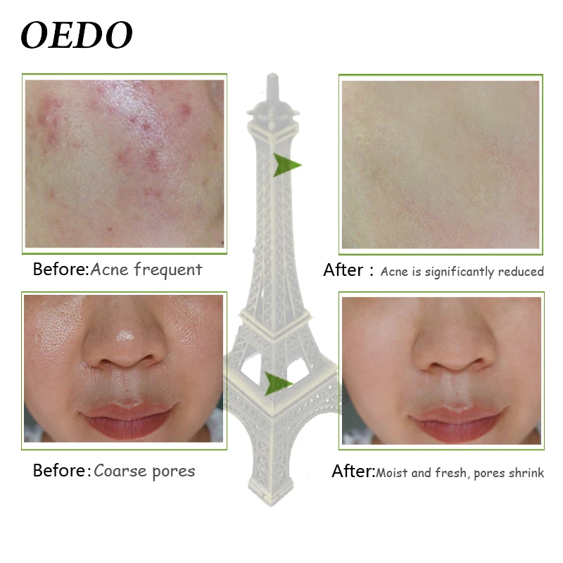 Водоросли алоэ вера гель увлажняющий отбеливающий день кремы Acne антивозрастной