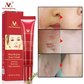 

Acne Scar Removal Cream Skin Repair Face Cream Acne Spots Acne Treatment Blackhead Whitening Cream Anti Scar Stretch Marks 15g