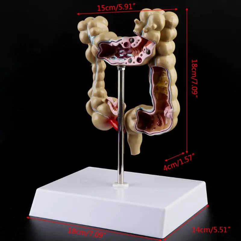Человека, модель поражения патологическая анатомия Колон заболеваний кишки для медицинской учебной обучающий инструмент