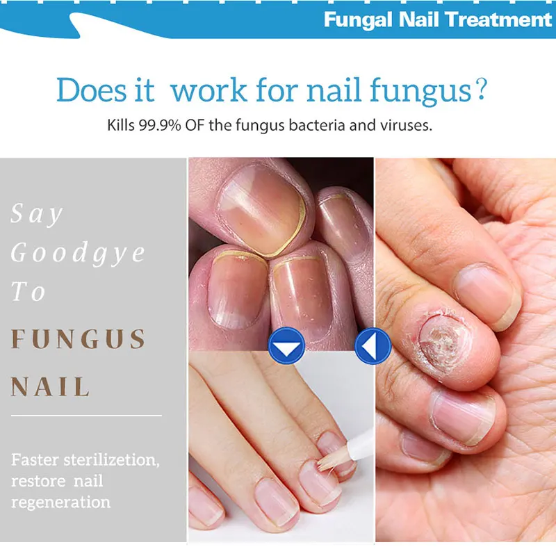 4 мл мощная жидкость для лечения Ногтей против грибковой инфекции ногтей китайские травяные средства для ухода за ногтями