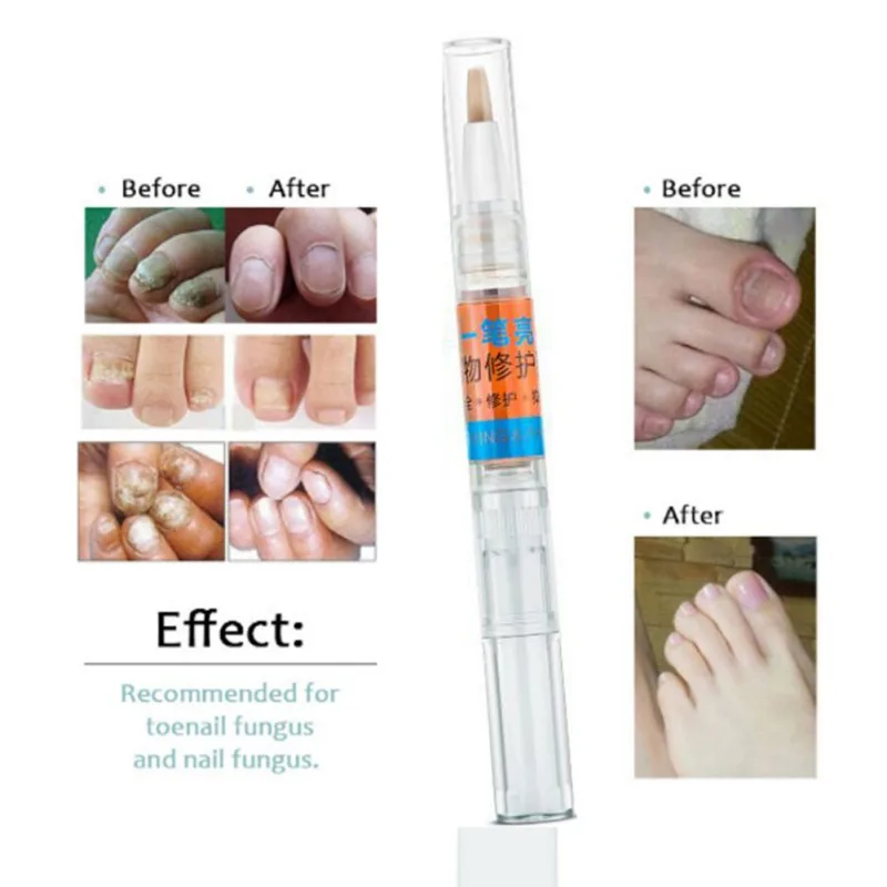 Fungal Nail Treatment Essence Liquid Nail Art Tool Foot Whitening Toe Nail Fungus Removal Nail/Feet Care Makeup