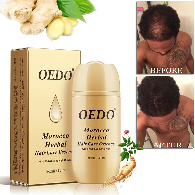 Moroccan Hair Tonic Hair Loss Treatment Ginseng Ginger Hair Growth Oil