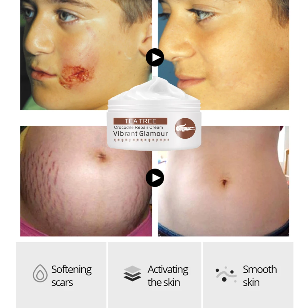 VIBRANT GLAMOUR Crocodile Repair Scar Cream Removal Scar Acne Treatment Marks  Deeply Repairs For Face Or Body  Skin Care Set