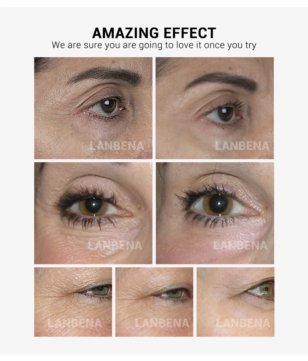 retinol on under eyes