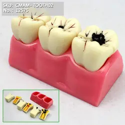 CMAM/12575 Dental-Decomposition of dental caries, Human Oral Dental Medical Teaching анатомическая модель