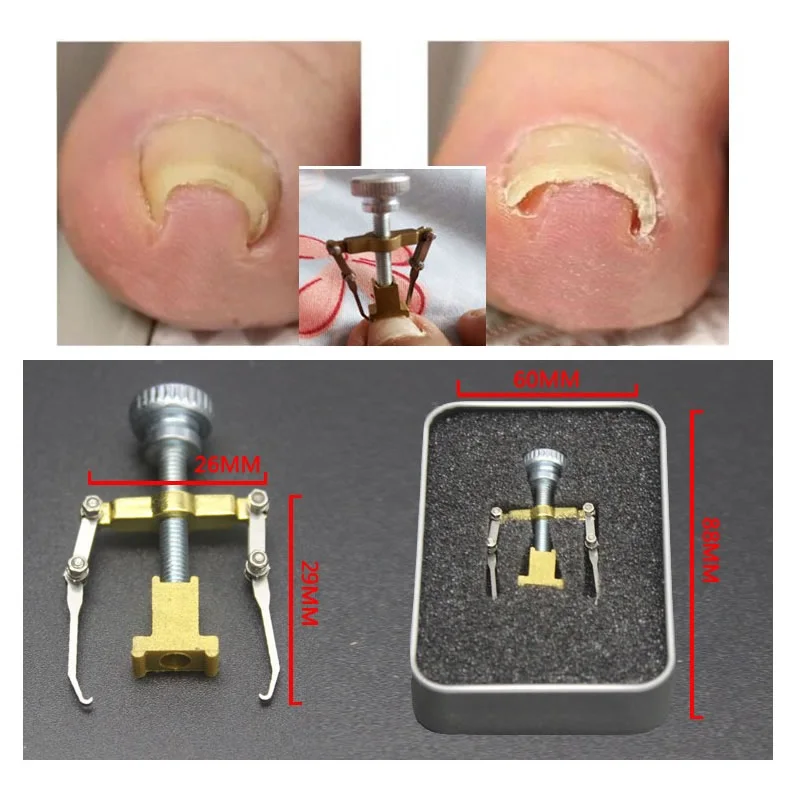 

Onychocryptosis appliance paronychia nail clippers Relieve Involution pain