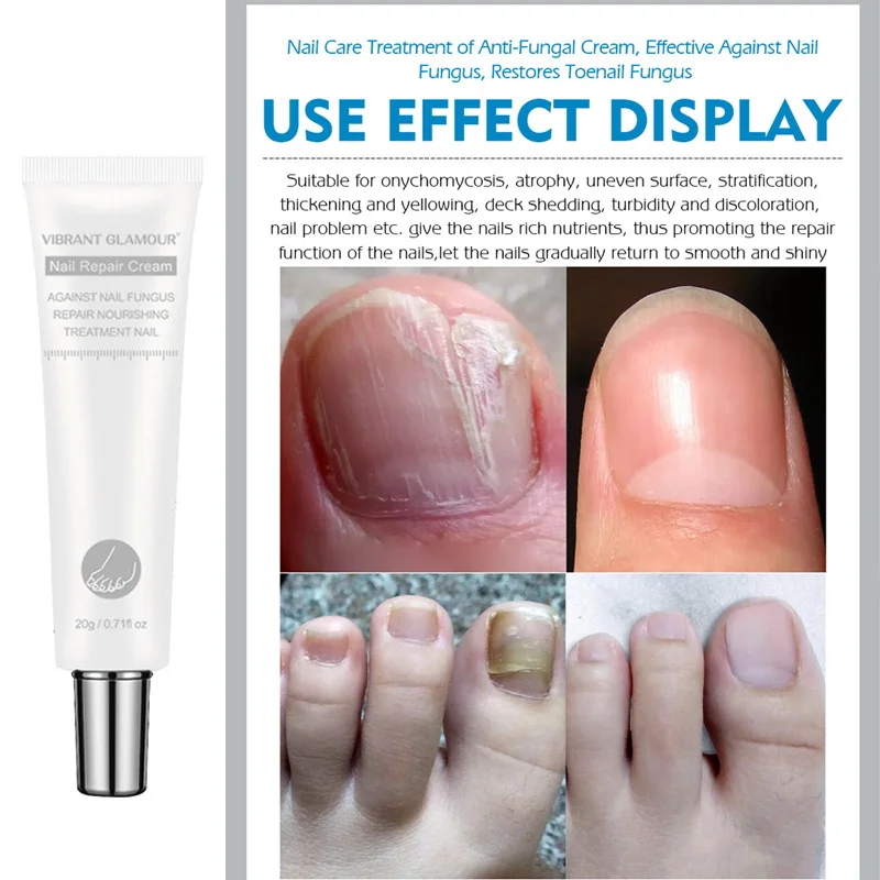 Nail Repair Cream Fungus Treatment Onychomycosis Removal Nail Toe Repair Cream OA66