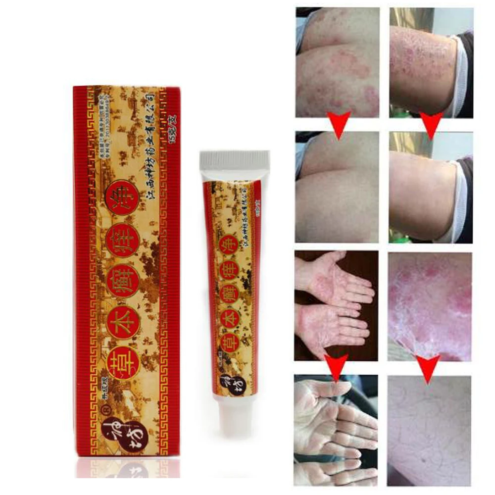 

High Quality Natural Chinese Medicine Herbal Anti Bacteria Cream Psoriasis Eczema Ointment Treatment Herbal Cream 15g D179