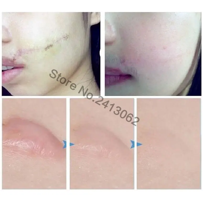 

100% Natural Authentic Anti Acne Spots Essence Oil Scar Removal Remove Cream for Belly Stretch Mark Skin Whitening Moisturizing