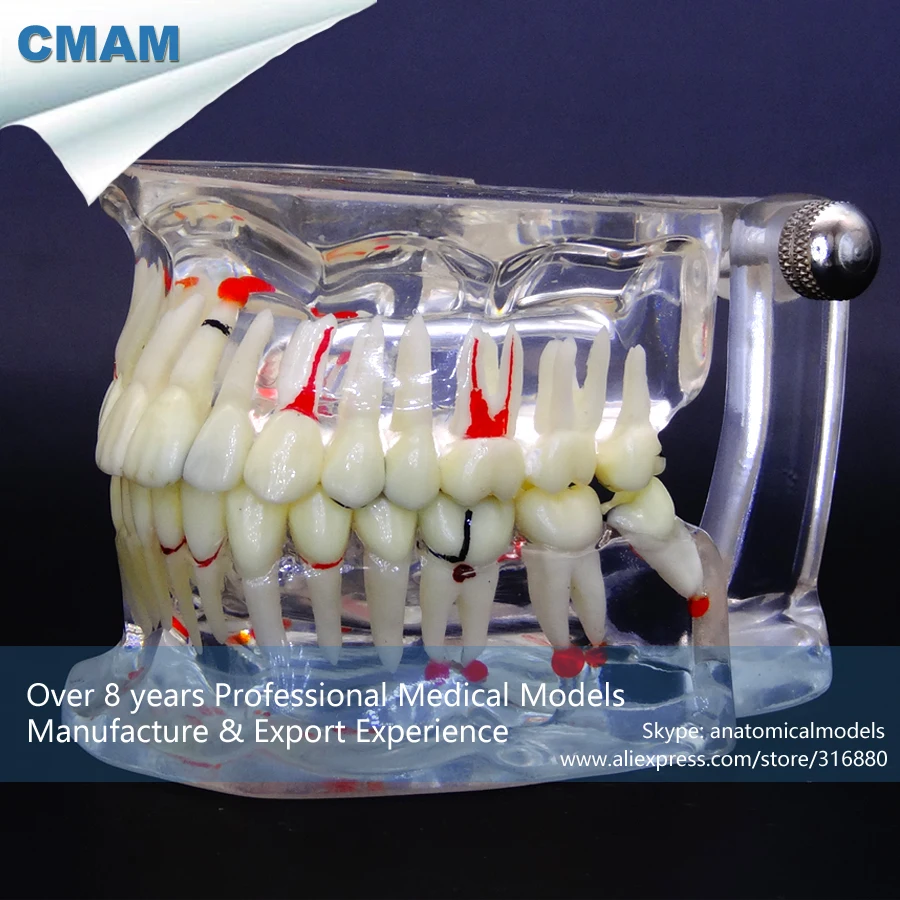 CMAM-DT4P03-1 Dental Patient Model Transparent Tooth Disease Adult Jaw Anatomy Model