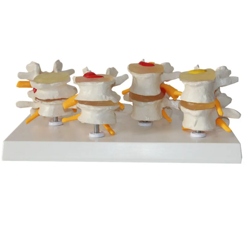 

4 Part Anatomical Human Lumbar Vertebrae Degenerative Disc Disease Medical Model