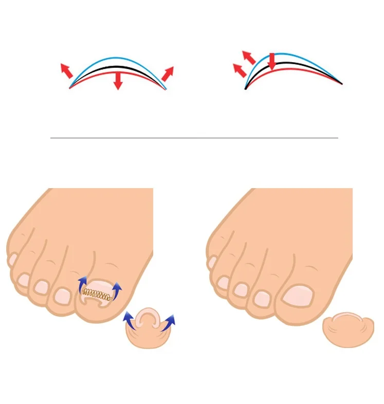 Monja 12pcs Ingrown Toe Nail Correction Wire Fixer Pedicure Paronychia Recover Toenails Corrector Foot Care Tool Monja 12pcs Ingrown Toe Nail Correction Wire Fixer Pedicure Paronychia Recover Toenails Corrector Foot Care Tool