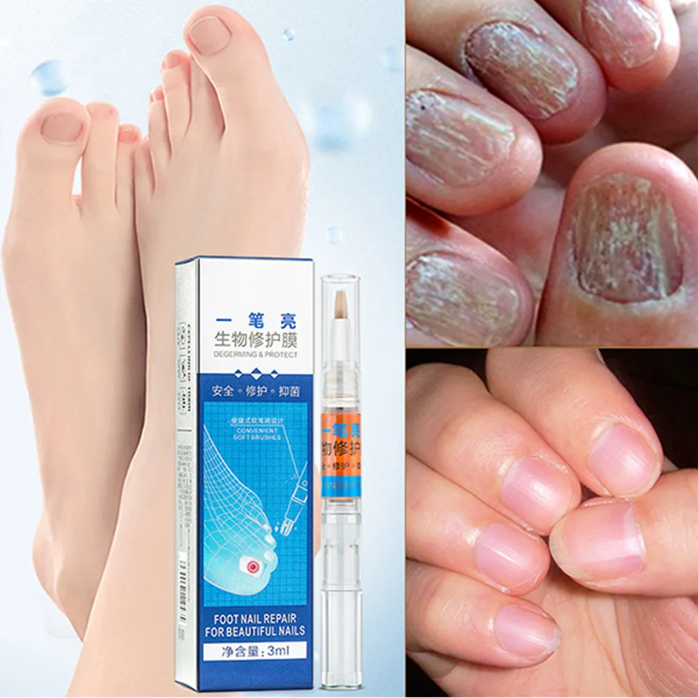 

Upgraded Version Anti Fungal Nail Treatment Pen Onychomycosis Paronychia Infection Toe Repair Nail Liquid Pen Brush TSLM2
