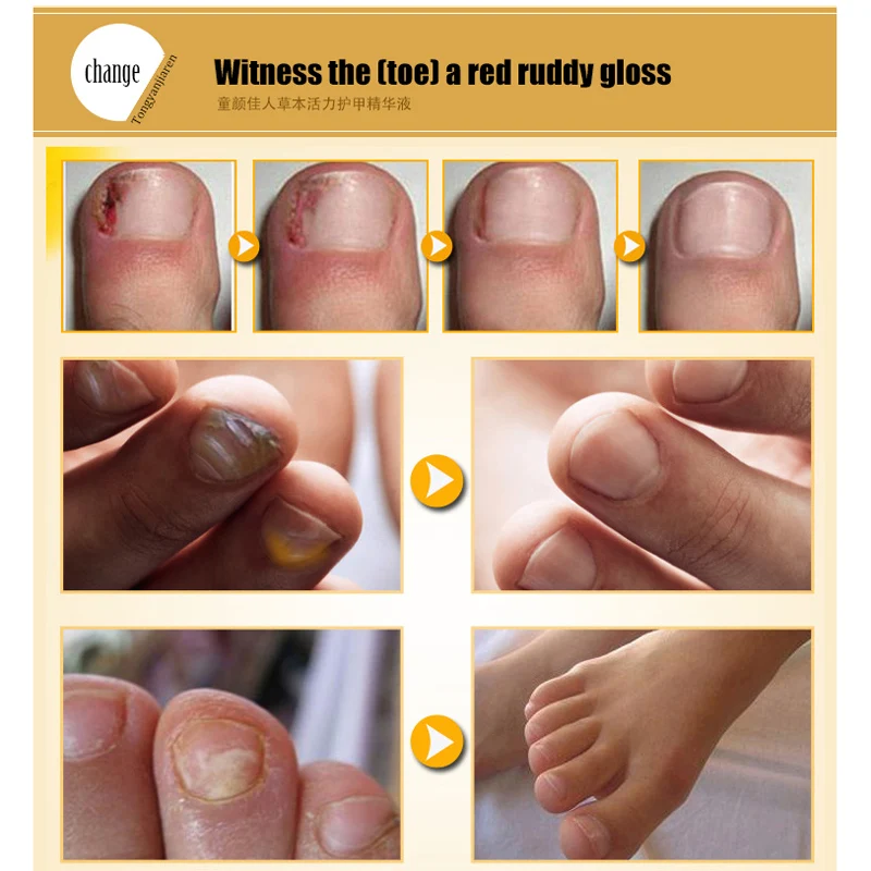 Полезное Лечение ногтей от грибка эссенция пальцев ног противогрибковый палец инфекция 30 мл