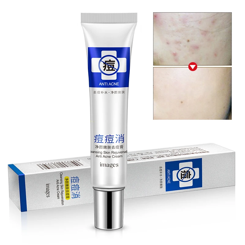 

Images 30ml Anti Acne Cream spot remover Oil Control Shrink Pores Acne Scar Remove Face Care Facial Skin Care Day Cream Smooth