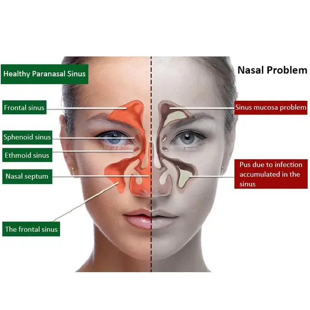 20ml Nasal Sprays Sinusitis Rhinitis Chronic Spray pruritus Chronic Rhinitis Sinusitis Spray Chinese Herb Medicine L4