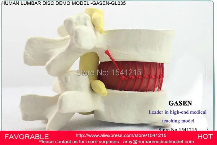 

HUMAN LUMBAR DISC HERNIATION DEMO MODEL LUMBAR MODEL ORTHOPEDICS SPINE HUMAN ORTHOPAEDICLUMBAR SPINE MODEL MODEL GASEN-GL035