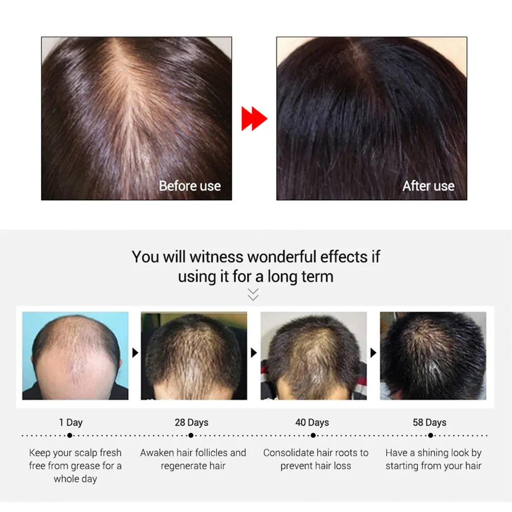 20 мл чистое эфирное масло Органическое средство для роста волос продукты эфирное масло лечение предупреждающий потерю волос
