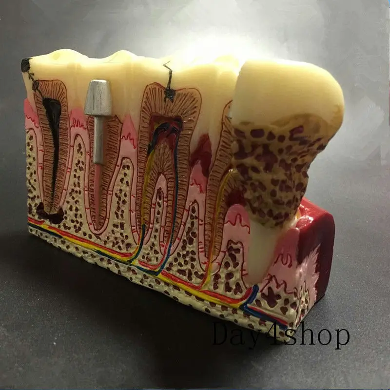 

Dental Anatomy of dental caries plastic teeth model demonstration communication