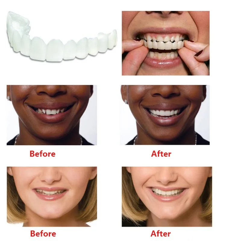 Orthodontic Dental Appliance Trainer Tooth Orthodontic Braces Alignment Braces For Teeth Straight Alignment