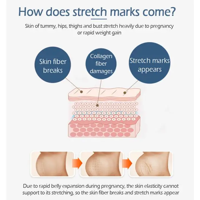 Стрейч Знаки ремонт крем послеродовой ремонт шрамы ожирение линии Лечение Уход за кожей HB88
