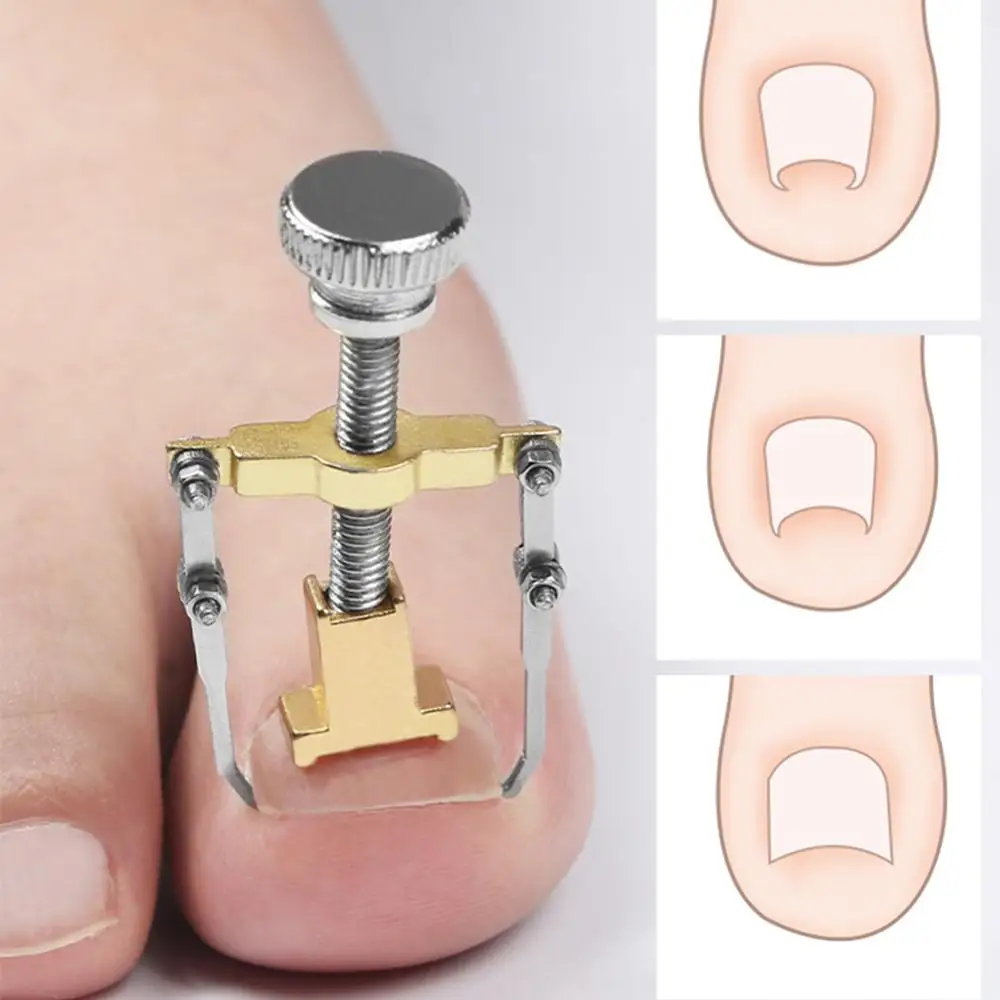 

Ingrown Toe Nail Recover Toenails Pedicure Foot Nail Ingrowing Care Tools Fixer Bunion Corrector For Toes CW31