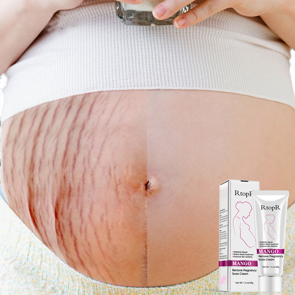 RtopR Natural Mild Non-irritating Mango Stretch Mark Cream Pregnancy Repair Scar Slack Line Abdomen Stretch Marks Cream TSLM1