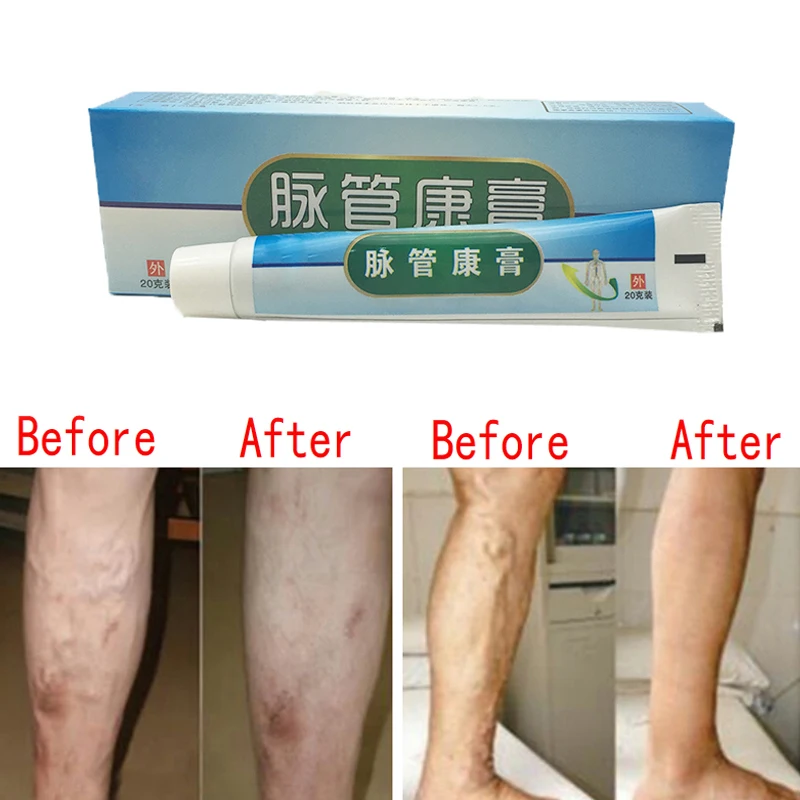 

Varicose Veins Ointment Veins Varicose Treatment Plaster Varicose Veins Cure Patch Vasculitis Natural Solution Herbal Patches