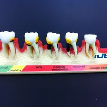 Стоматологическая модель зубов пародонтальная болезнь Assort зуб классификация модель 1 шт