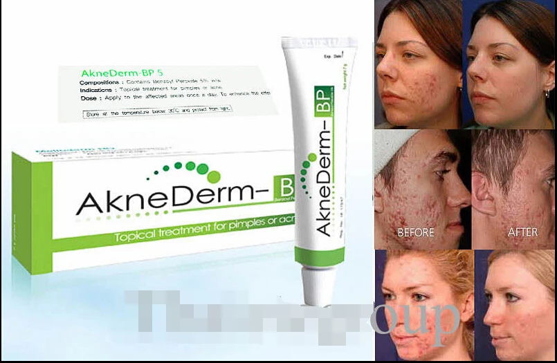 Gel A Base De Peroxyde De Benzoyle : Propranolol Avlocardyl Gel A Base De Peroxyde De Benzoyle : Propranolol Avlocardyl