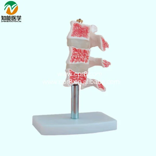

Human Osteoporosis Anatomical Model (3 Vertebrae) BIX-A1015 WBW142