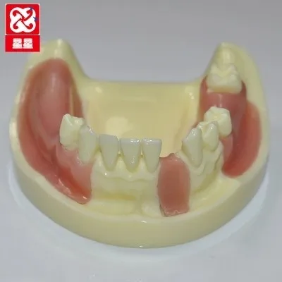 Falta de Simulação do Modelo de Implantes Dentários Dentes Perdidos Frete Grátis 2 Cheap Ciência médica