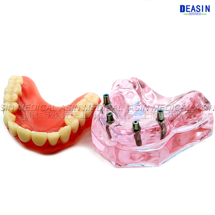 1 шт. x Высокое качество смолы покрытие Зубной Имплантат модель протезы съемные зубы модель для стоматологического исследования Deasin