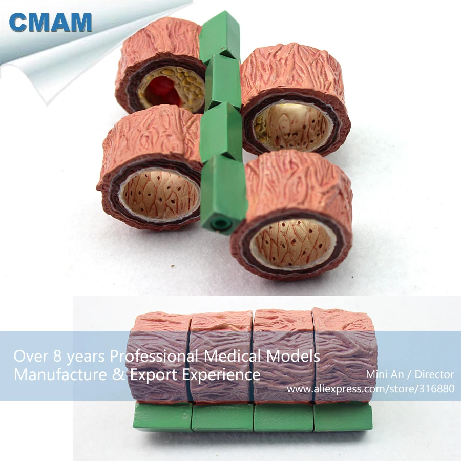 

12483 / CMAM-HEART07 4-Stage Artery Cholesterol Atherosclerosis Model, Medical Science Educational Teaching Anatomical Models