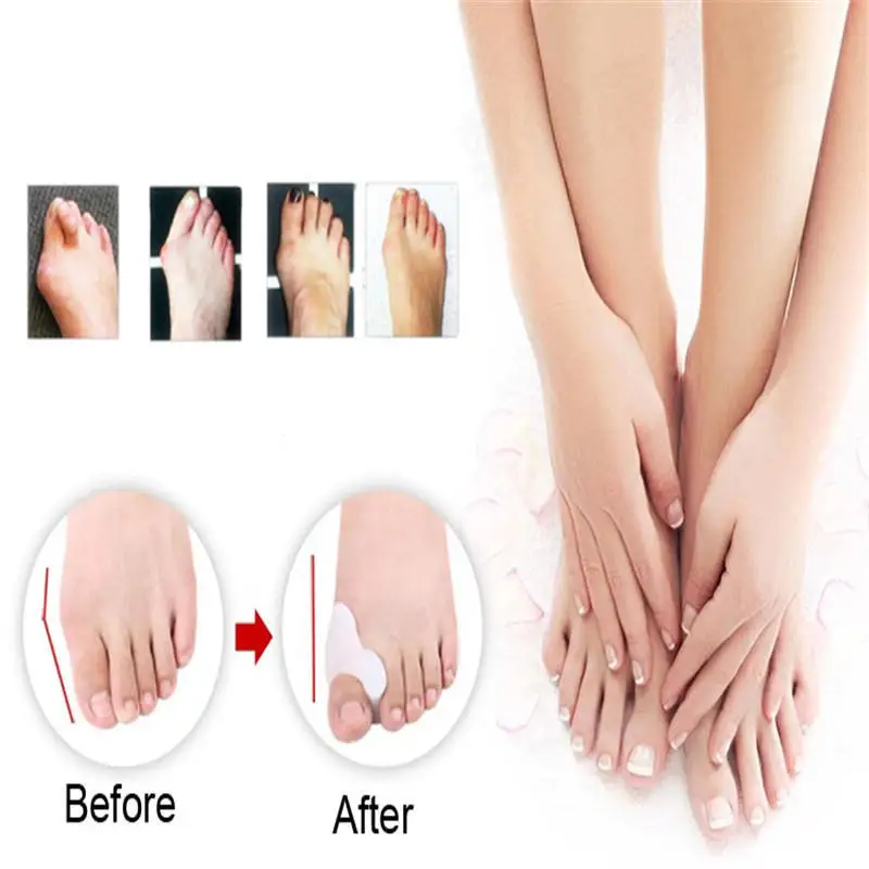 Soin de 2 pièces/paire pieds protecteur d'oignon en Gel de Silicone séparateur de redresseur d'orteils alignement soulagement de la douleur correcteur de pouce orthèses ► Photo 3/4