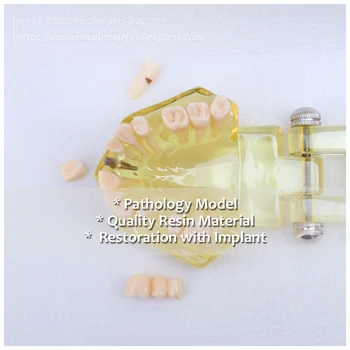 

DH/13069, Restoration with Implant, Pathology Dental Model, Medical Science Educational Teaching Anatomical Models