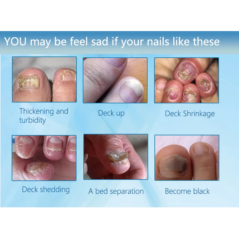 Professional Herb Nail Antibacterial Oil Nail Repair Nourishment Antifungal Brightening Toe Finger Fungus Removal Nail Care Oil